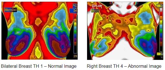 Breast images