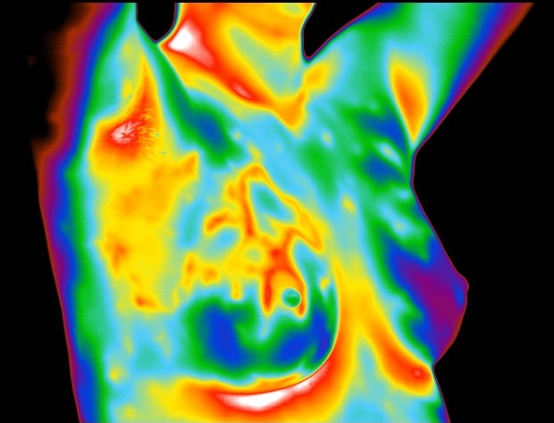 What Does It Mean to Have Dense Breasts? - Thermography